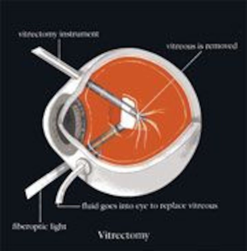 Vitrectomy Systems Vitreous Surgery (Vitrectomy)