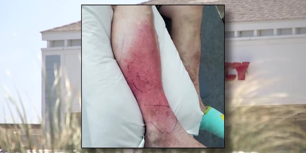 Fish Handlers Rash Fisherman fighting flesh-eating bacteria infection as cases climb ...